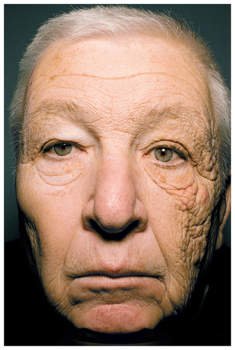 UVA Sun Damage